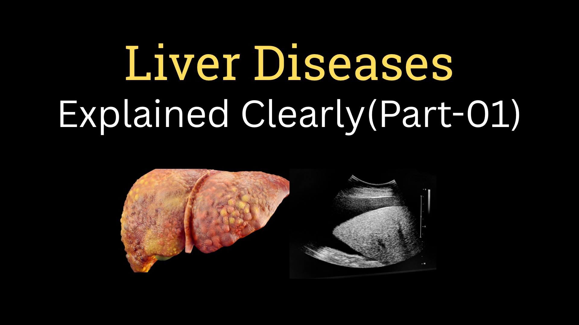 <h1><strong>Liver Disease—Part 01</strong></h1>
