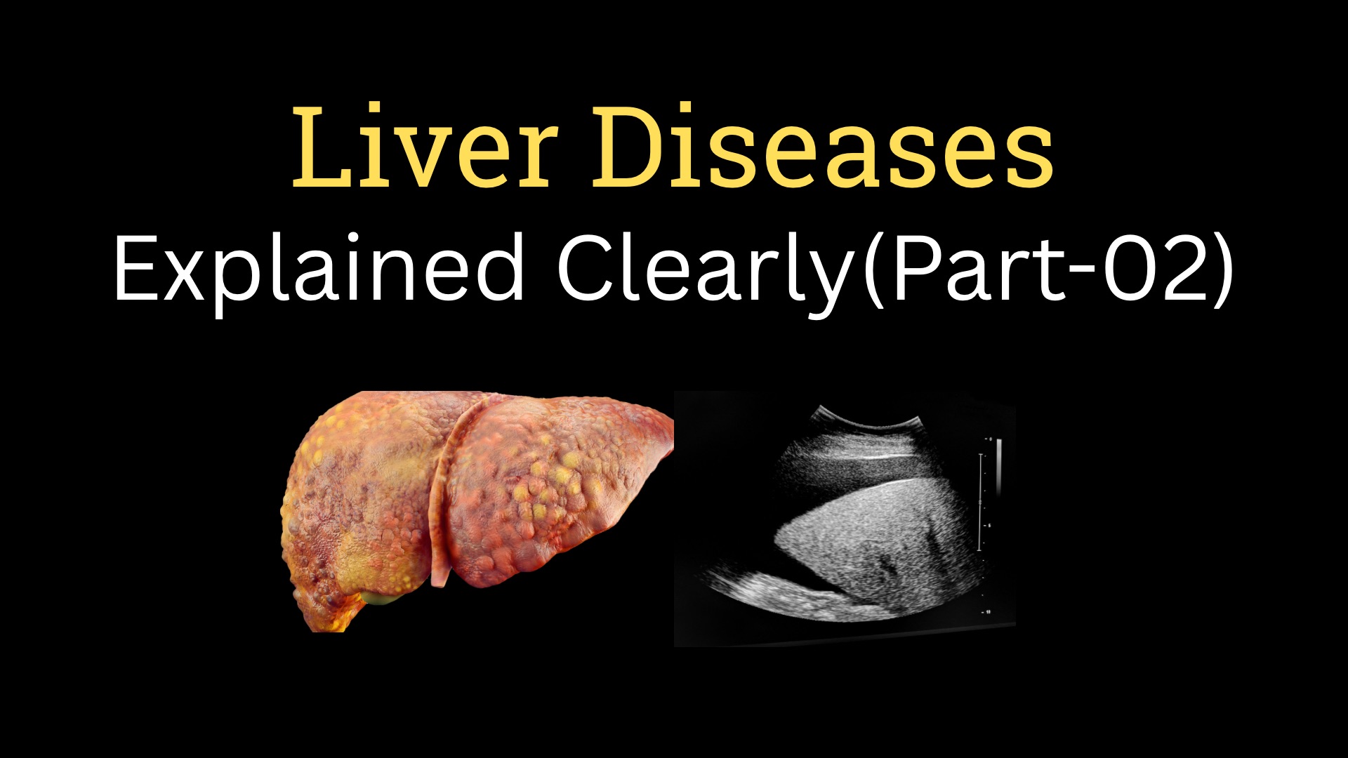 <h1><strong>Liver Disease—Part-02</strong></h1>